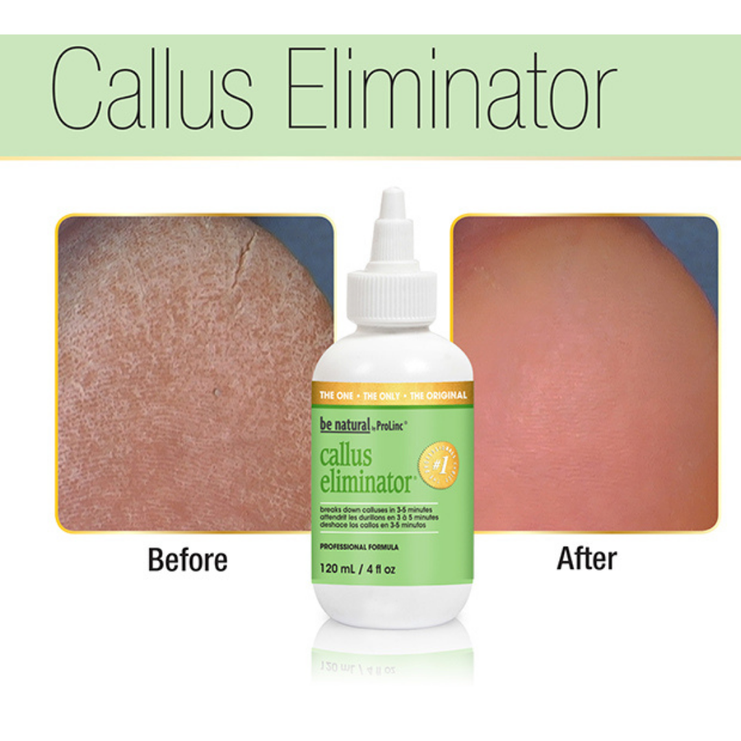A bottle of Callus Eliminator professional formula centered on a white background, with before-and-after skin close-ups shown on both sides. Large text at the top reads 'Callus Eliminator' with 'Before' and 'After' labels below the comparison panels.
